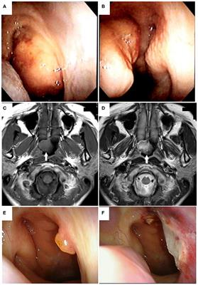 Clinicopathological Features of Thyroid-Like Low-Grade Nasopharyngeal Papillary Adenocarcinoma: A Case Report and Review of the Literature